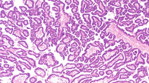 Tumori ginecologici: ricerca e formazione al CNAO